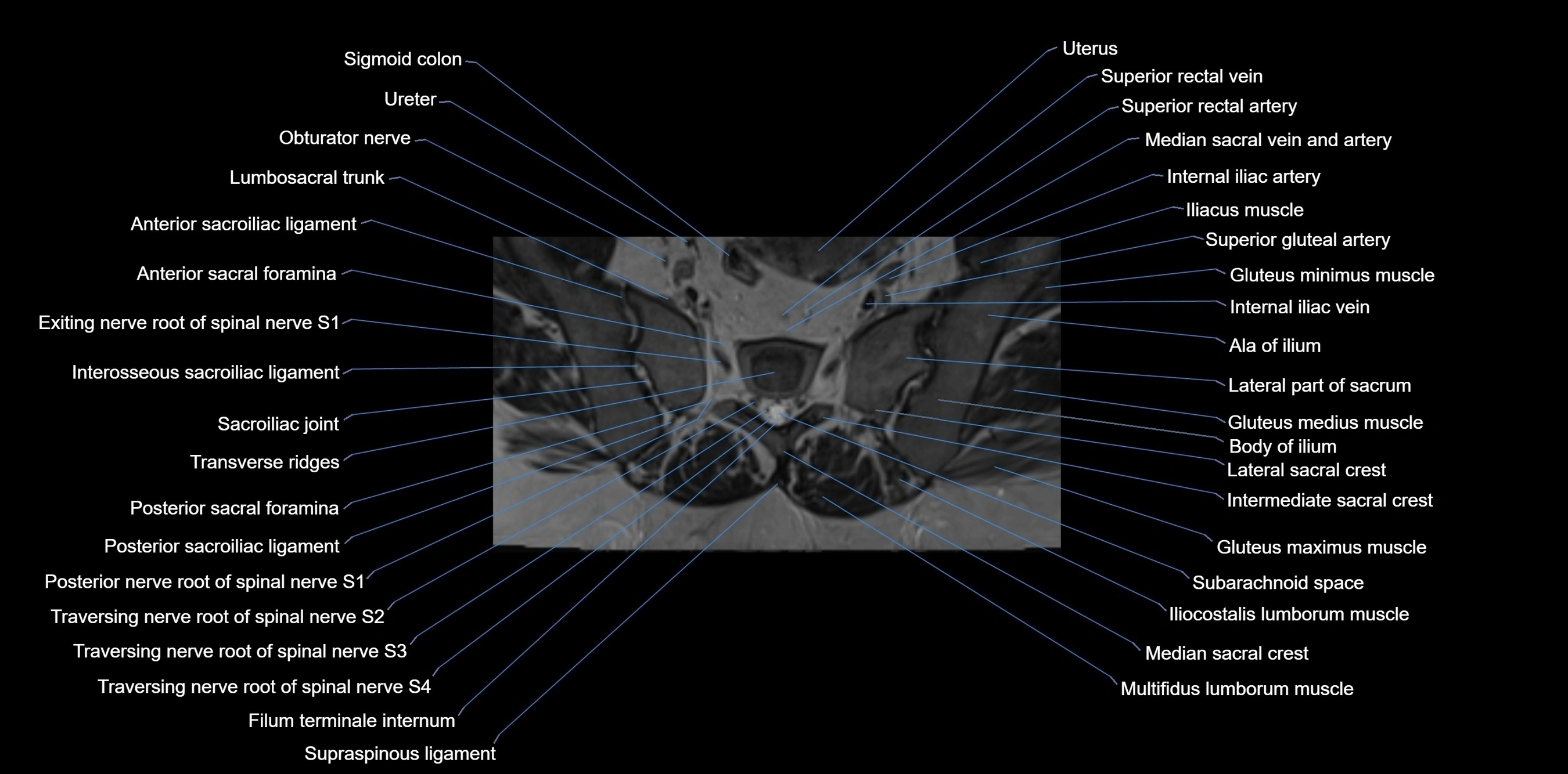 MRI sacrum, coccyx and sacroiliac joint axial cross sectional anatomy 3T  radiology  image-img-00001-00020.webp